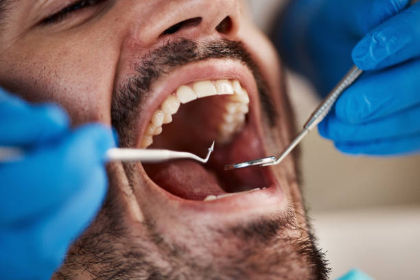 Best Emergency Root Canal Treatment in Princess Anne, MD